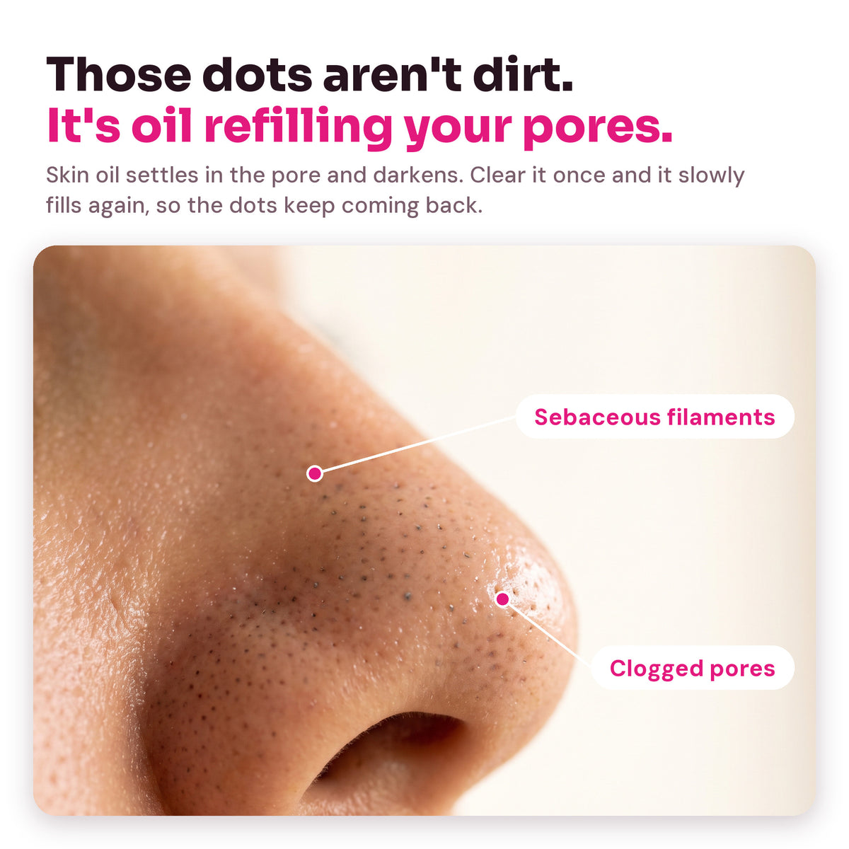 Close-up of a nose with clogged pores and sebaceous filaments