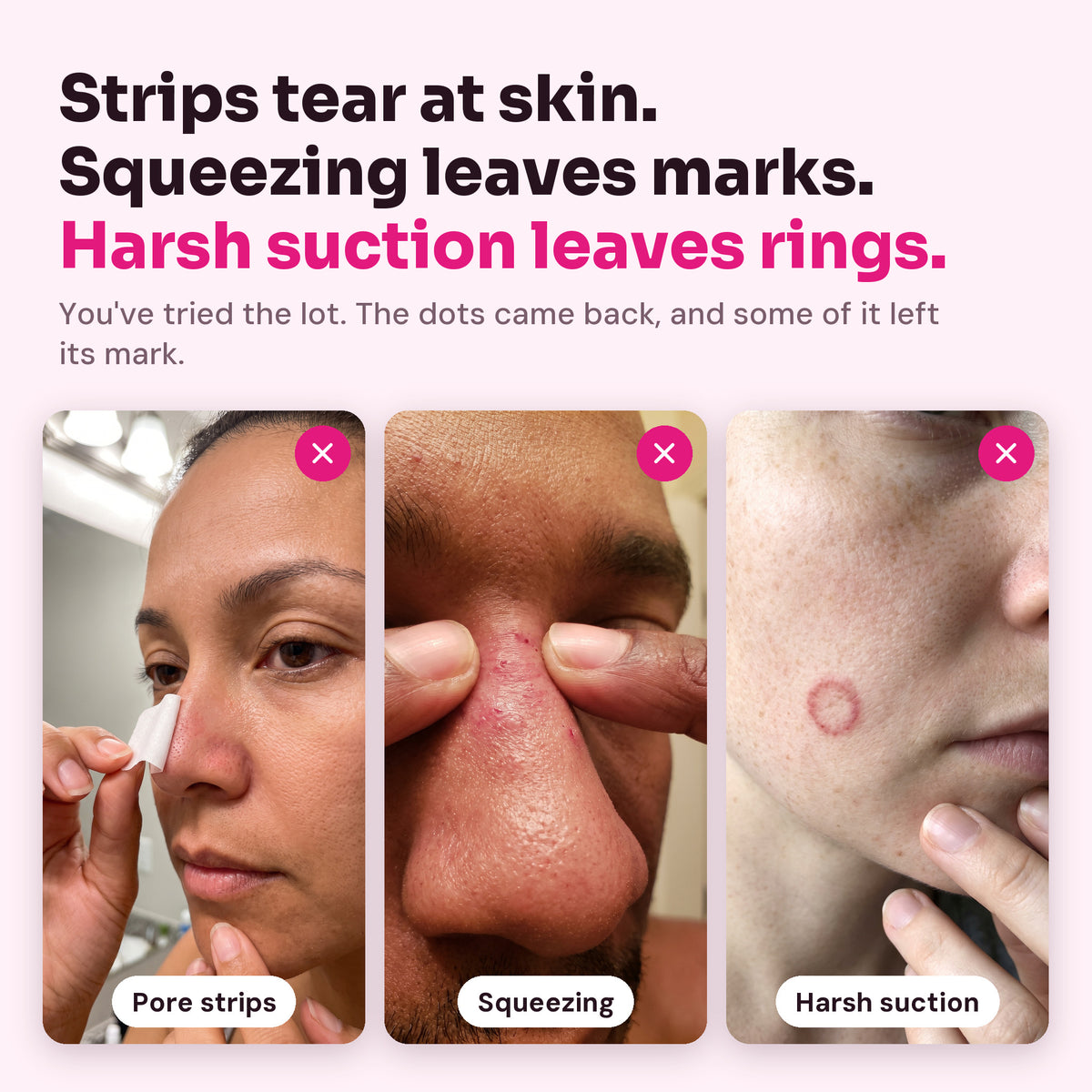 Pore strips, squeezing and harsh suction and the marks they leave