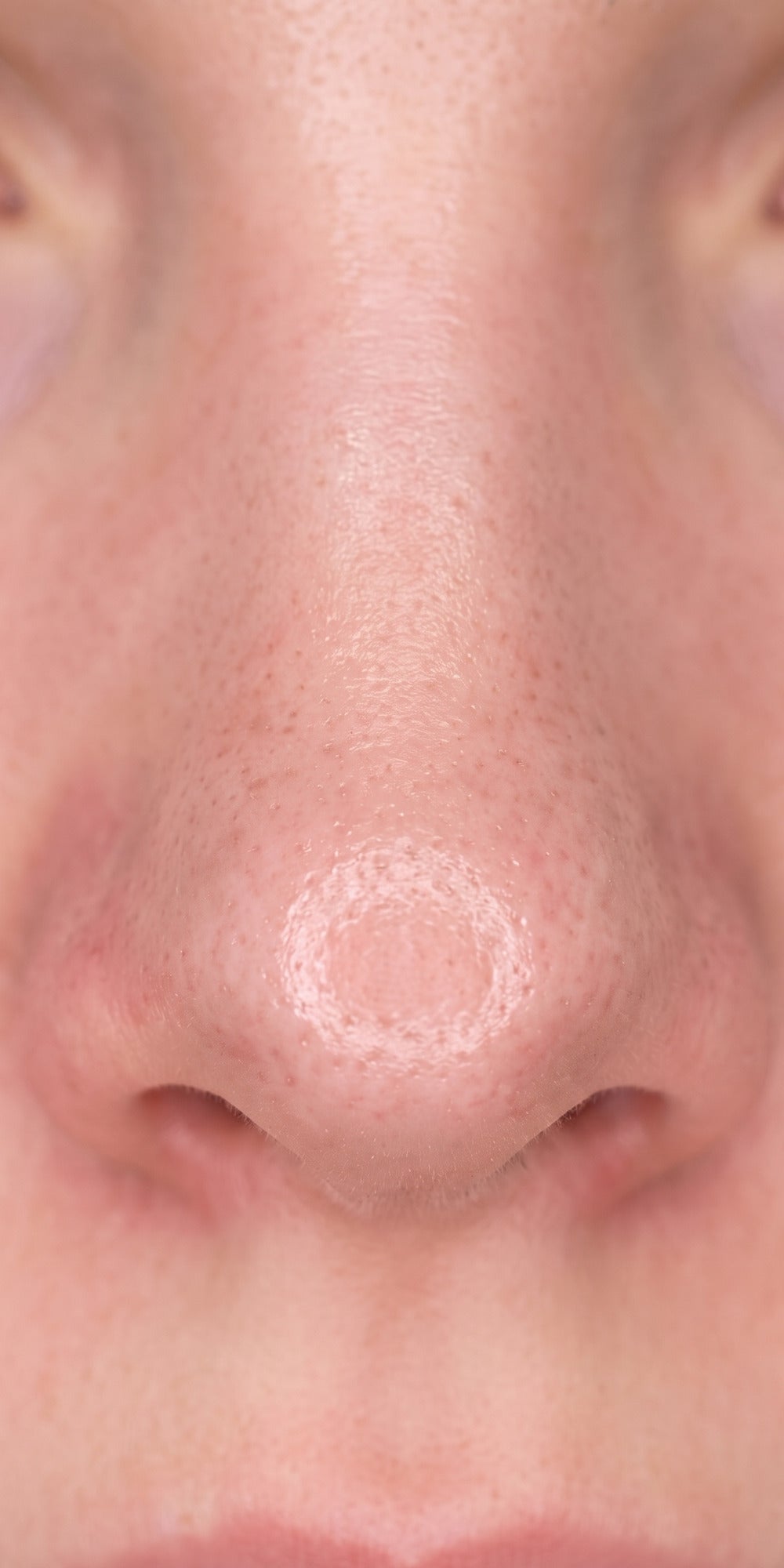 Nose after a RENA session, pores looking clearer
