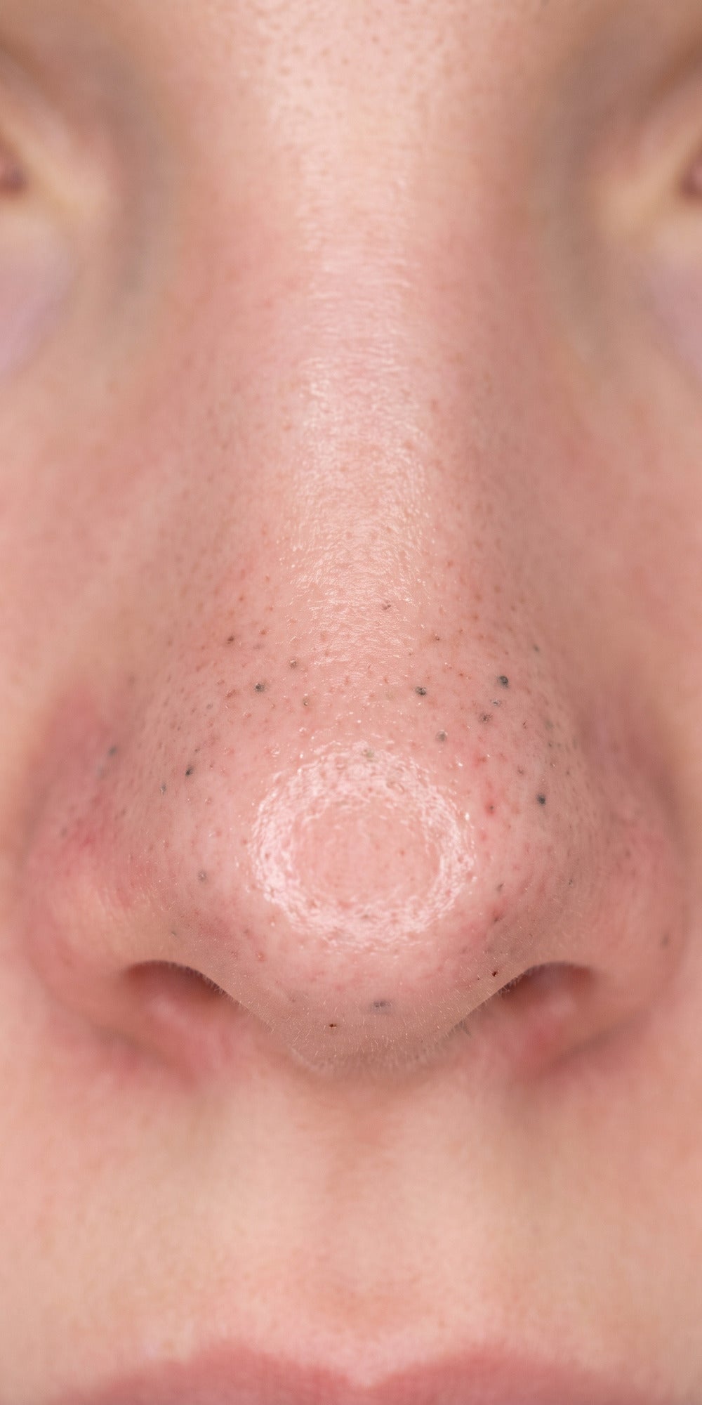 Nose before, visible dots across the pores
