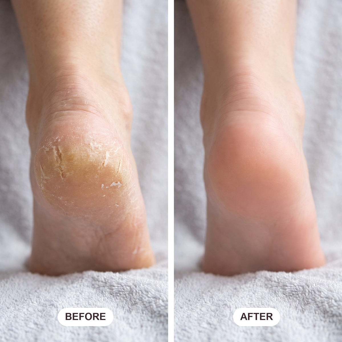 Heel before and after SAMMET Pro